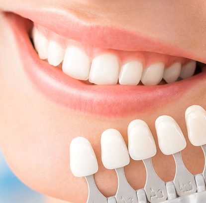 Dental Veneers: A Quick Fix for Chipped, Gapped, and Stained Teeth